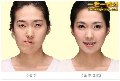 korean_plastic_surgery_39.jpg