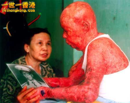 Agent-Orange-dioxin-skin-damage-Vietnam_LjqfDwOgGnEk.jpg