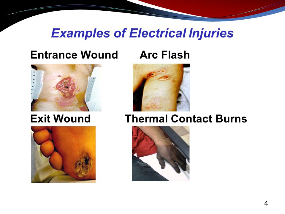 Electrocution Wounds