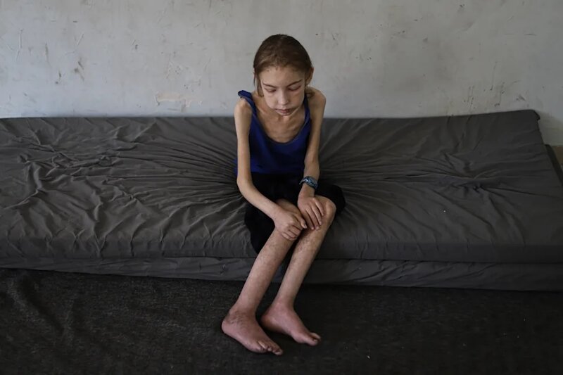 1   12 歲的 Rahaf Ayyad 正在掙扎求存，其瘦弱身軀是源於營養不良及無法就診的疾病。.jpg