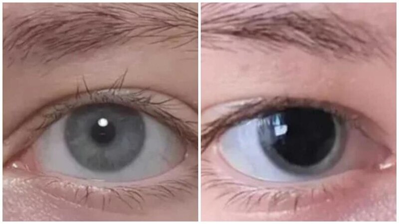 對比之下，右邊相片中的瞳孔放得超大，顏色又黑又深，看去十分異常。(Reddit).jpg