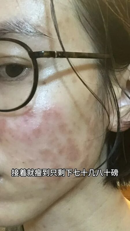 3 免疫系統出問題，全身皮膚開始紅腫。.jpg